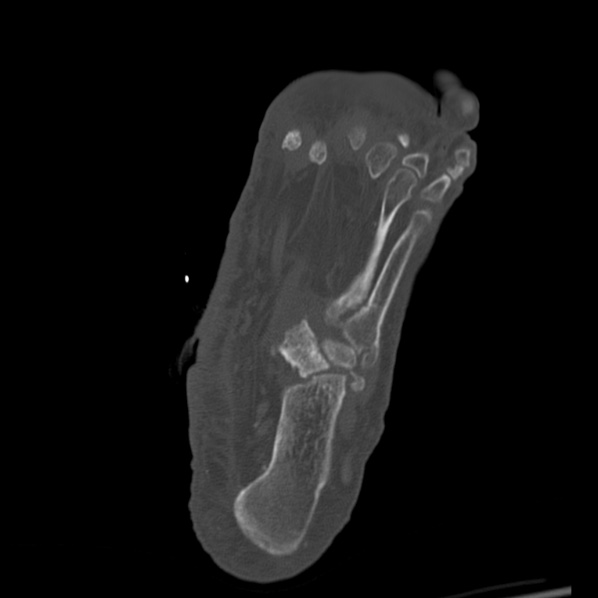 Charcot joint (Radiopaedia 36629-38194 Axial bone window 59).jpg