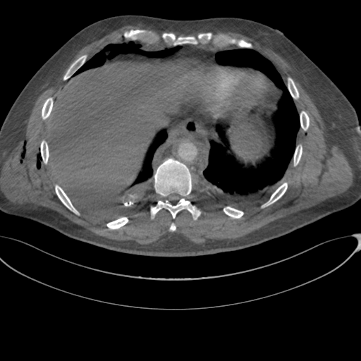 File:Chest multitrauma - aortic injury (Radiopaedia 34708-36147 A 234).png