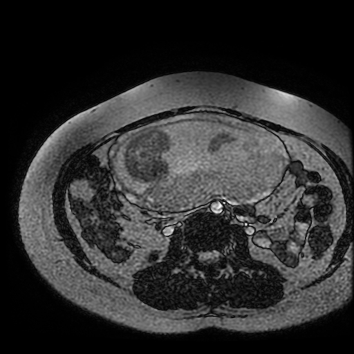 Chiari II malformation - fetal MRI (Radiopaedia 68099-77581 Axial Fiesta 2).jpg