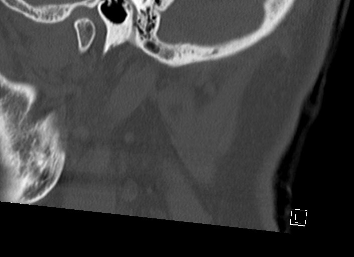 Chiari I malformation with a symptomatic syrinx of the posterolateral medulla oblongata (Radiopaedia 42573-45707 A 54).jpg