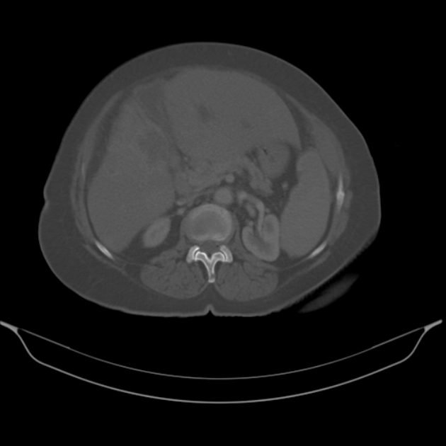 Cholangiocarcinoma (Radiopaedia 50592-56025 Axial bone window 29).jpg