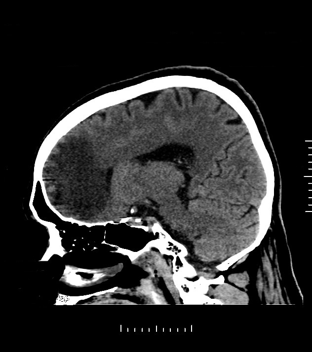 Cholangiocarcinoma with cerebral metastases (Radiopaedia 83519-98628 C 32).jpg