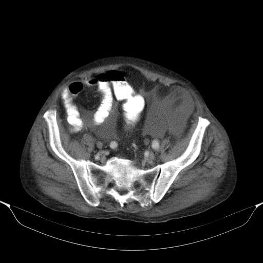 File:Cholangitis and abscess formation in a patient with cholangiocarcinoma (Radiopaedia 21194-21100 A 40).jpg