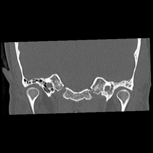 File:Cholesteatoma (Radiopaedia 84960-100474 Coronal bone window 26).jpg
