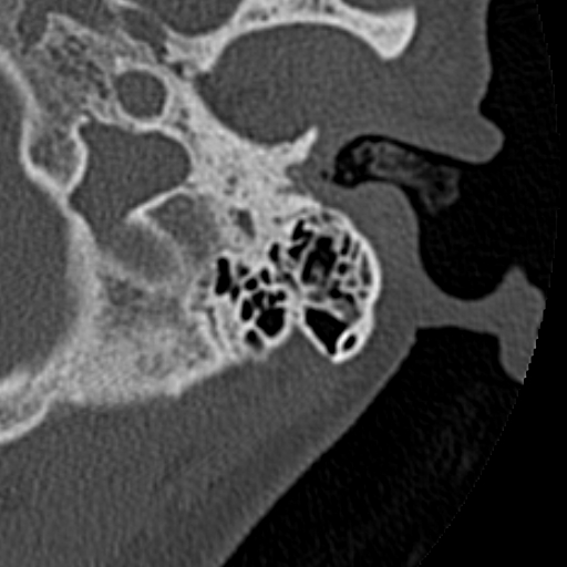 File:Cholesteatoma of the external ear (Radiopaedia 16540-16225 Axial bone window 30).jpg