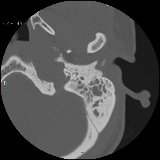 File:Cholesterol granuloma of the petrous apex (Radiopaedia 64358-73141 Axial bone window 69).jpg