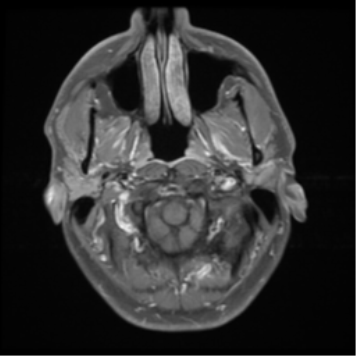 File:Chondrosarcoma (clivus) (Radiopaedia 46895-51424 Axial STIR 6).png
