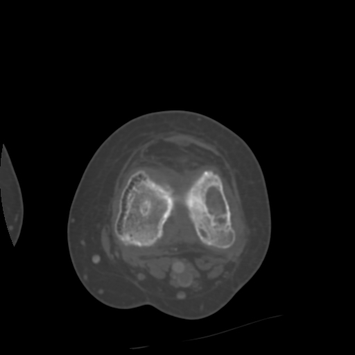 Chondrosarcoma - femur (Radiopaedia 64187-72954 Axial bone window 47).jpg