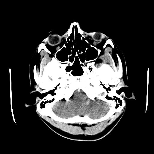File:Choriocarcinoma of ovary with cerebral and pulmonary metastases (Radiopaedia 25983-26118 C+ arterial phase 15).jpg