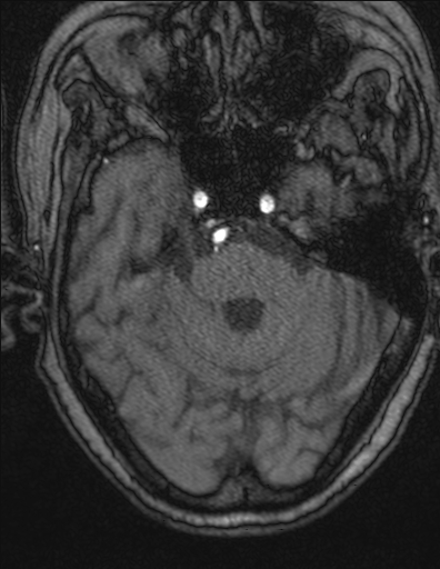 Choroid plexus xanthogranuloma - unilateral (Radiopaedia 85632-101393 Axial TOF 5).jpg
