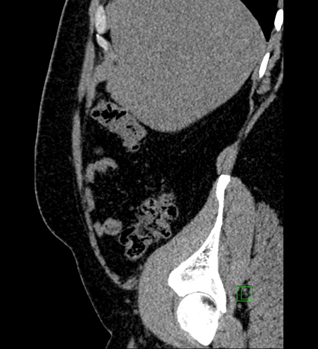 Chromophobe renal cell carcinoma (Radiopaedia 84286-99573 C 150).jpg