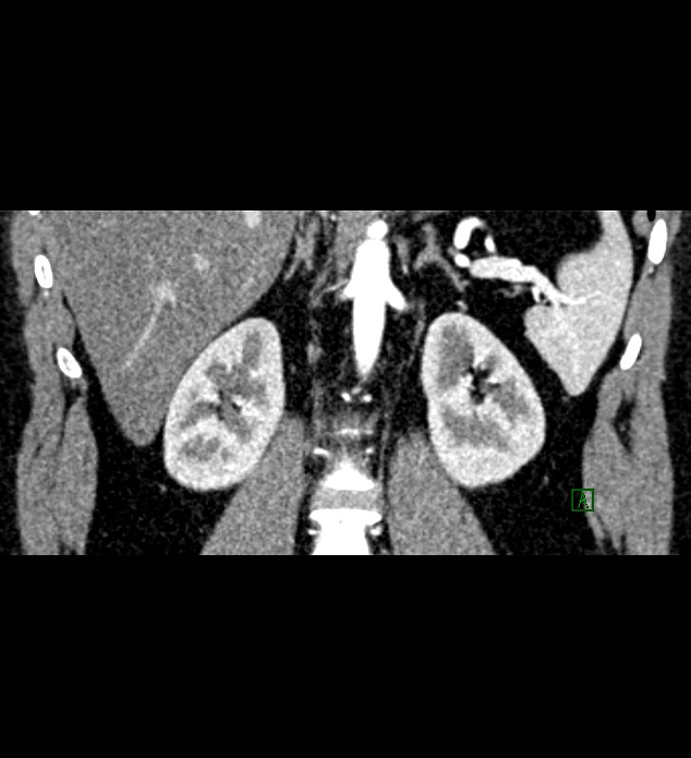 Chromophobe renal cell carcinoma (Radiopaedia 84286-99573 E 53).jpg