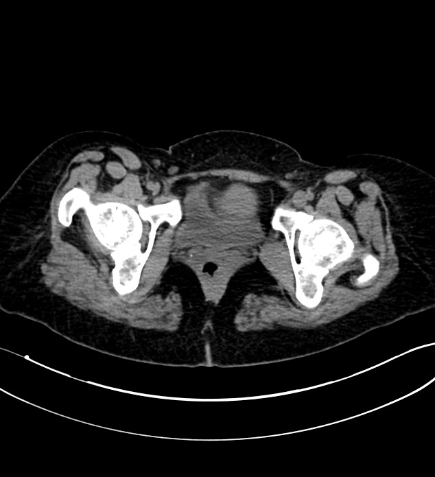 Chromophobe renal cell carcinoma (Radiopaedia 84290-99582 Axial non-contrast 145).jpg