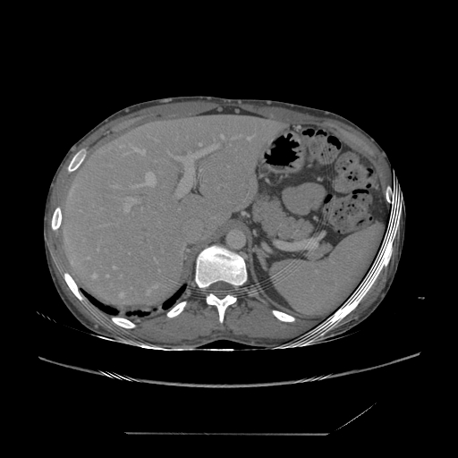 File:Chronic IVC thrombosis and resultant IVC filter malposition (Radiopaedia 81158-94800 A 31).jpg