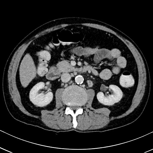 Chronic appendicitis complicated by appendicular abscess, pylephlebitis and liver abscess (Radiopaedia 54483-60700 B 71).jpg