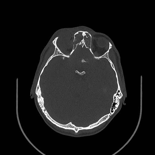 Chronic invasive fungal sinusitis (Radiopaedia 50342-55710 Axial bone window 97).jpg