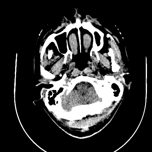 Chronic invasive fungal sinusitis (Radiopaedia 91563-109286 Axial non-contrast 1).jpg