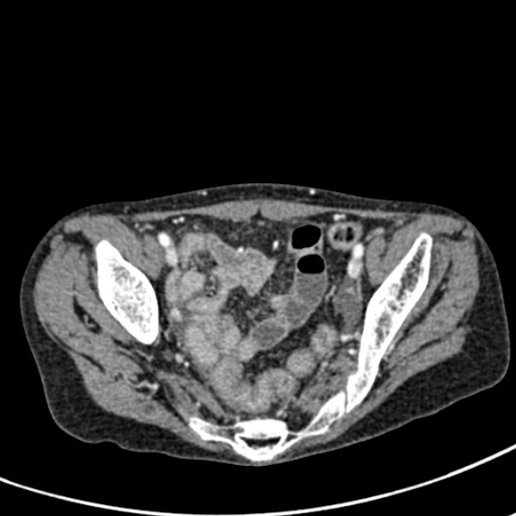 File:Chronic pancreatitis (Radiopaedia 55405-61846 A 90).jpg