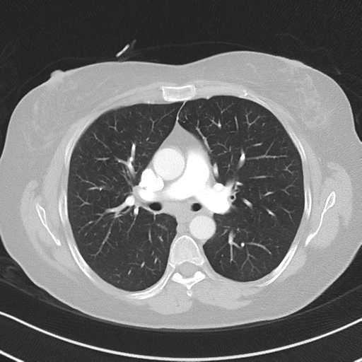 Chronic pulmonary embolus (Radiopaedia 39129-41341 Axial lung window 28).png