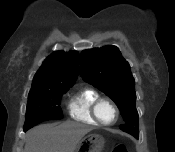 Chronic pulmonary embolus (Radiopaedia 39129-41341 Coronal C+ CTPA 23).png
