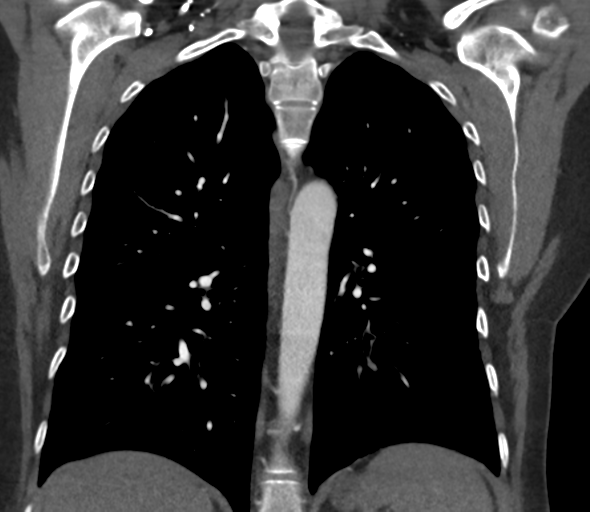 Chronic pulmonary embolus (Radiopaedia 39129-41341 Coronal C+ CTPA 56).png