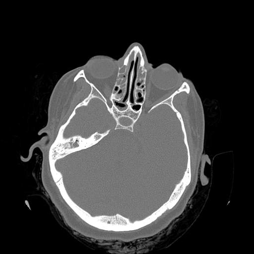 Chronic sinusitis with intra-sinus calcification (Radiopaedia 63919-72668 Axial bone window 19).jpg