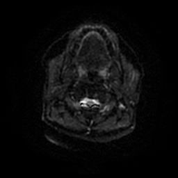 Chronic submandibular sialadenitis (Radiopaedia 61852-69885 Axial DWI 41).jpg