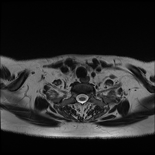 File:Chronic submandibular sialadenitis (Radiopaedia 61852-69885 Axial T2 30).jpg