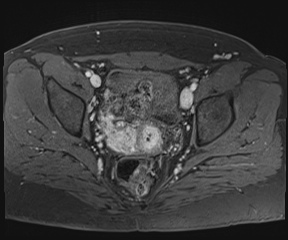 File:Class II Mullerian duct anomaly- unicornuate uterus with rudimentary horn and non-communicating cavity (Radiopaedia 39441-41755 Axial T1 fat sat 76).jpg