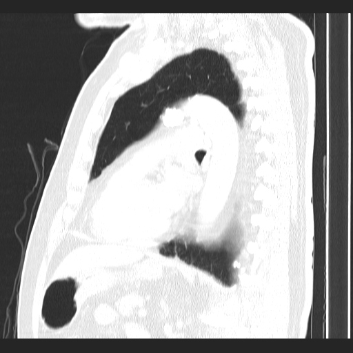 File:Classic complicated silicosis (Radiopaedia 49720-54961 Sagittal lung window 25).jpg