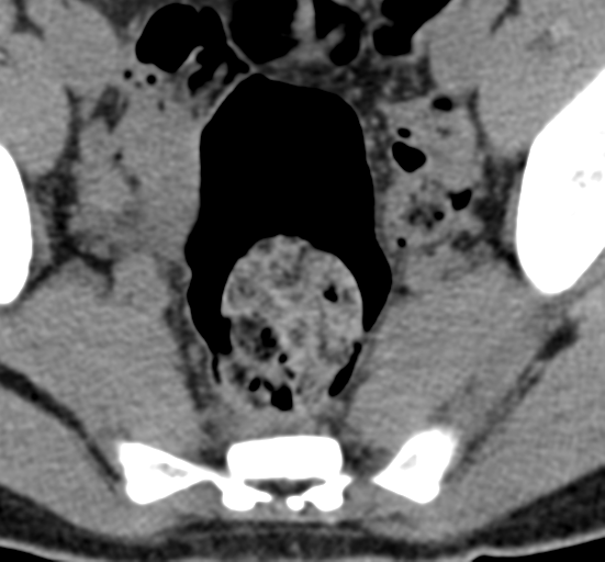File:Clear cell meningoma - lumbar spine (Radiopaedia 60116-67691 Axial non-contrast 86).png