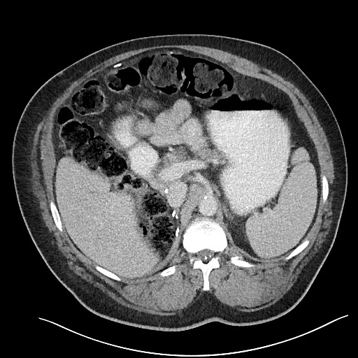 File:Closed loop obstruction - internal hernia into nephrectomy bed (Radiopaedia 59867-67320 A 42).jpg