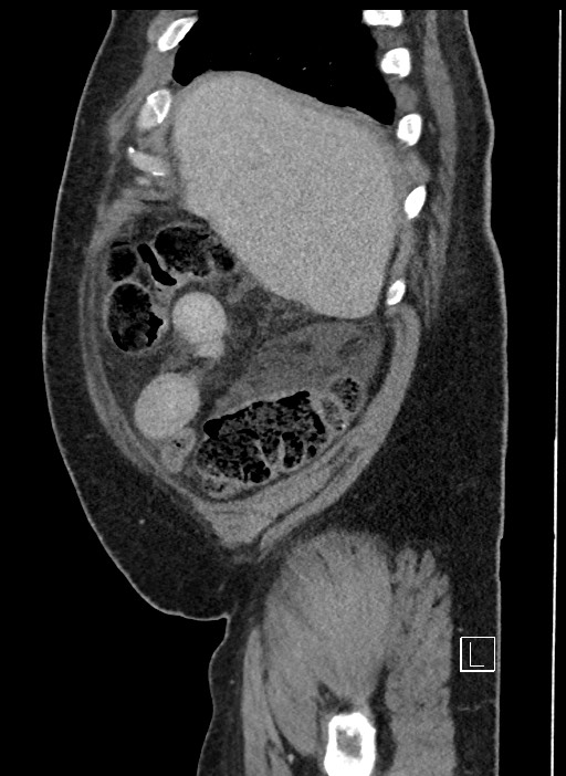 Closed loop obstruction - internal hernia into nephrectomy bed (Radiopaedia 59867-67320 C 95).jpg