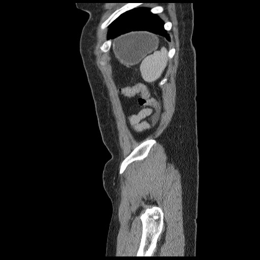 File:Closed loop small bowel obstruction (Radiopaedia 65403-74451 C 100).jpg