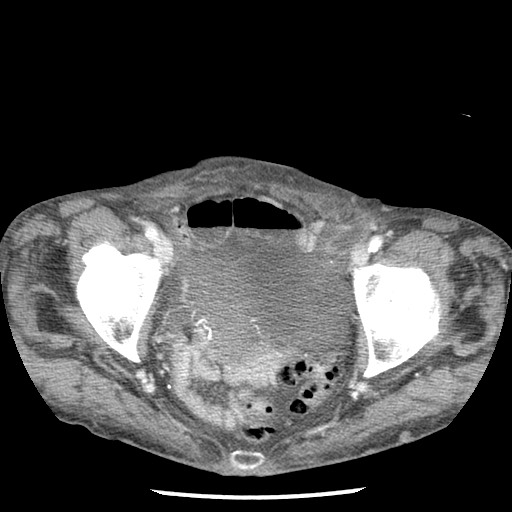 Closed loop small bowel obstruction - adhesions and infarct (Radiopaedia 85125-100678 B 94).jpg