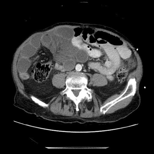 Closed loop small bowel obstruction - adhesive disease and hemorrhagic ischemia (Radiopaedia 86831-102990 A 118).jpg