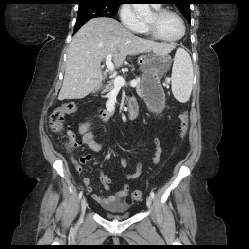 Closed loop small bowel obstruction - internal hernia (Radiopaedia 65402-74450 B 49).jpg