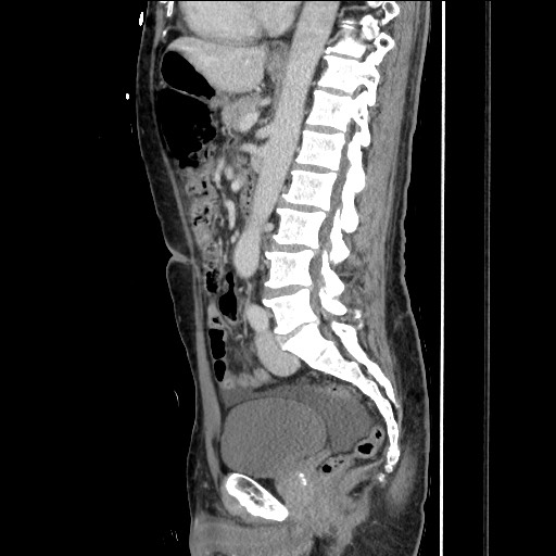 Closed loop small bowel obstruction - omental adhesion causing "internal hernia" (Radiopaedia 85129-100682 C 100).jpg
