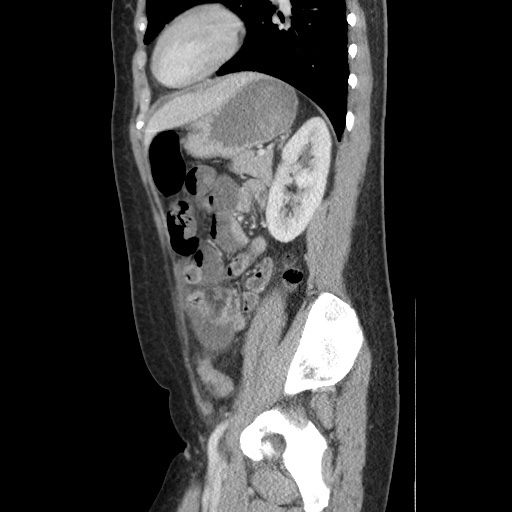 Closed loop small bowel obstruction due to trans-omental herniation (Radiopaedia 35593-37109 C 46).jpg