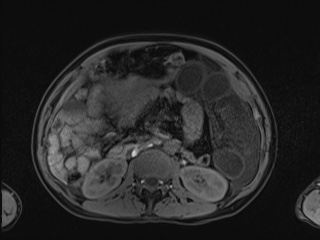 Closed loop small bowel obstruction in pregnancy (MRI) (Radiopaedia 87637-104031 Axial T1 fat sat 56).jpg