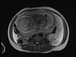 File:Closed loop small bowel obstruction in pregnancy (MRI) (Radiopaedia 87637-104031 Axial T2 43).jpg