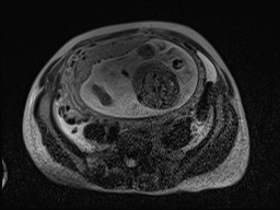 Closed loop small bowel obstruction in pregnancy (MRI) (Radiopaedia 87637-104031 D 15).jpg