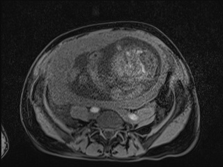 Closed loop small bowel obstruction in pregnancy (MRI) (Radiopaedia 87637-104031 F 26).jpg
