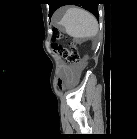 Closed loop small bowel obstruction with ischemia (Radiopaedia 84180-99456 C 18).jpg