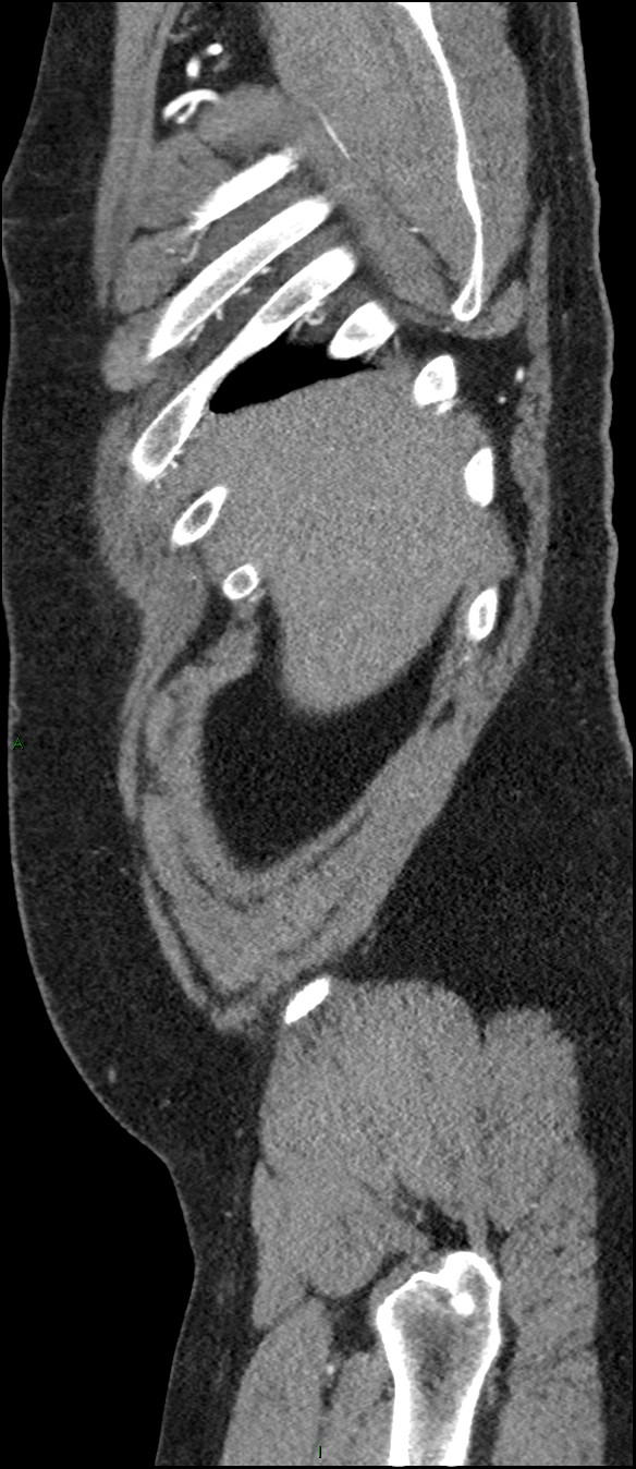 Coarctation of the aorta (Radiopaedia 74632-88521 C 24).jpg
