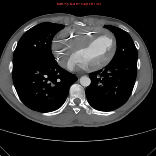 File:Coarctation of the aorta (Radiopaedia 9434-10118 A 127).jpg