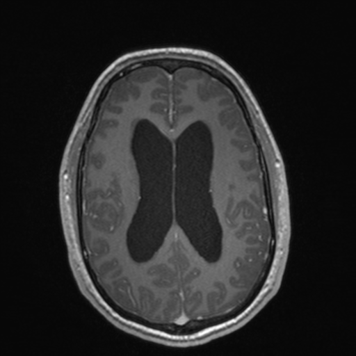 File:Colloid cyst (Radiopaedia 44510-48181 Axial T1 C+ 116).png