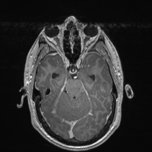 File:Colloid cyst (Radiopaedia 44510-48181 Axial T1 C+ 68).png