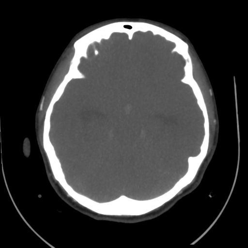 File:Colloid cyst (resulting in death) (Radiopaedia 33423-34499 A 22).png