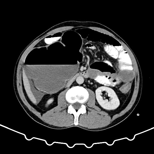 File:Colocolic intussusception due to large lipoma (Radiopaedia 68773-78482 A 84).jpg